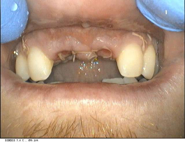 dentist-geelong-newtown-dentist-dental-clinic-newtown-aviva-implants-before-after-case2-1